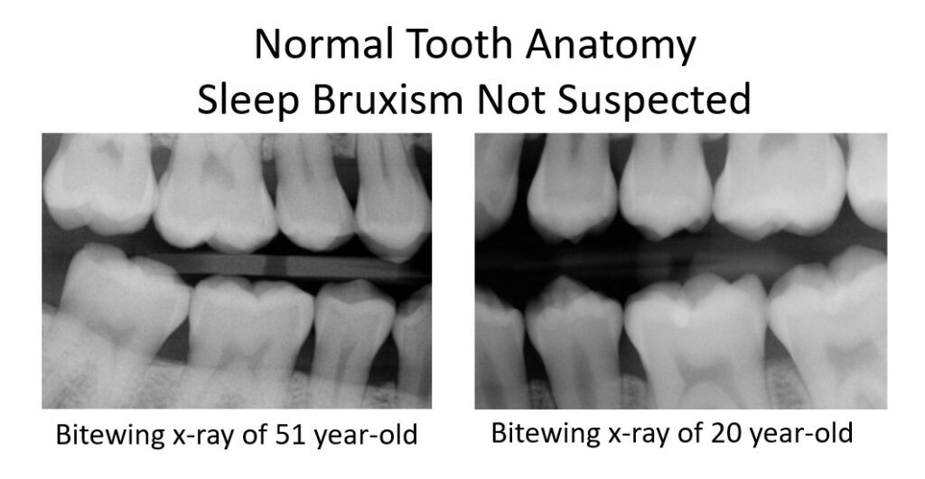 why-do-people-grind-their-teeth-while-sleeping-informed-dental-consumer