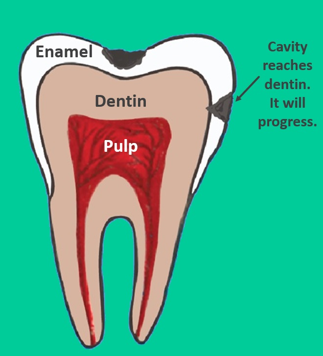 Dental Cavity Stages | Informed Dental Consumer